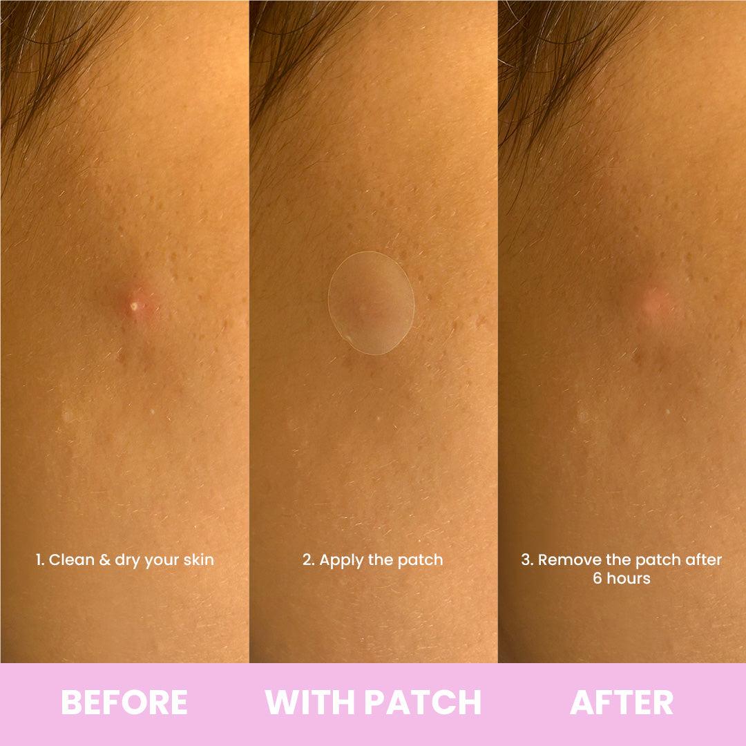 NEEDLY Blemish Patch 24ea